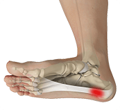 Picture of Plantar Fasciitis