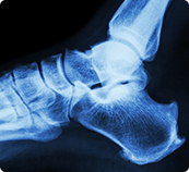 Individual grimacing while grasping their foot and ankle