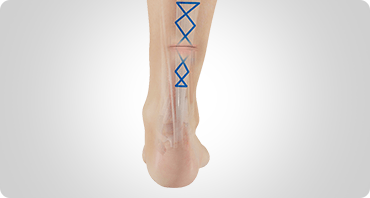 Picture of Achilles Tendon Repair