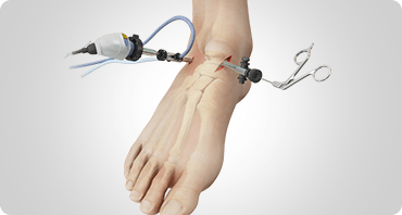 Picture of Ankle Arthroscopy