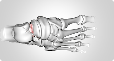 Picture of Ankle Fracture Surgery