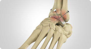 Picture of Ankle Fusion