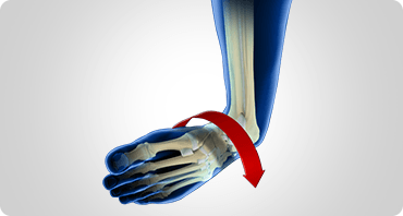 Picture of Ankle Instability Surgery