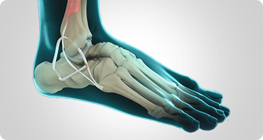 Picture of Ankle Ligament Reconstruction