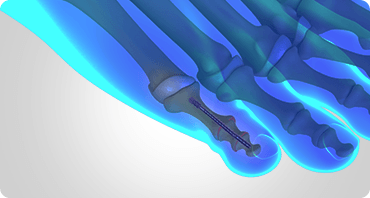 Picture of Hammertoe Correction