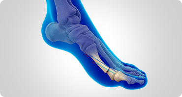 Picture of Minimally Invasive Bunion Surgery