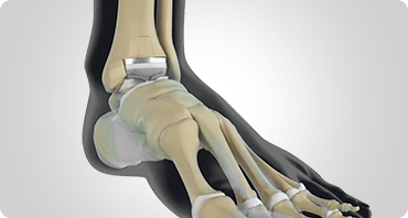 Picture of Total Ankle Joint Replacement