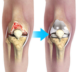 Complex Total Knee Replacement