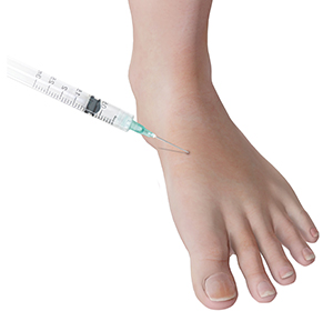 Corticosteroid Injections