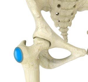 Hip Bursitis