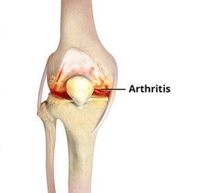 Nonoperative Management of Knee Arthritis