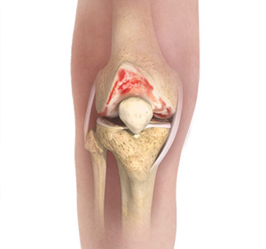 Knee Osteoarthritis