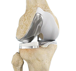 Mako Robotic-Arm Assisted Technology for partial knee replacement
