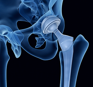 Mako Robotic-Arm Assisted Technology for total hip replacement