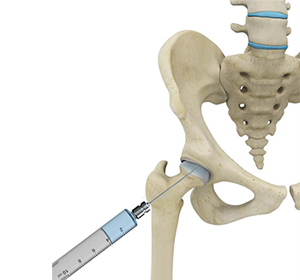 Nonoperative Management of Hip Arthritis