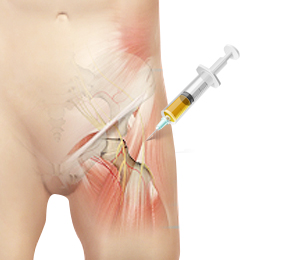 Platelet Rich Plasma (PRP) Injections for the Hip