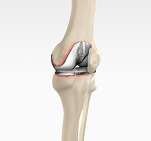 Revision Knee Replacement