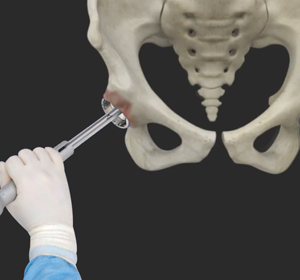 Robotic Assisted Hip Replacement
