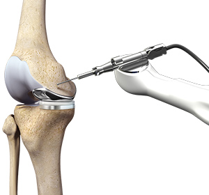 Mako Robotic-Arm Assisted Technology for Total Knee replacement