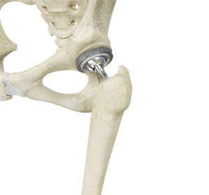 Total Hip Replacement