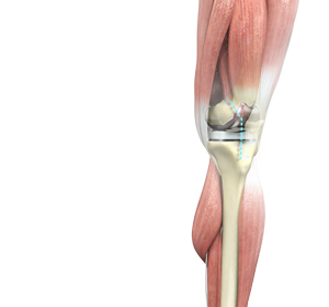 Total Knee Replacement