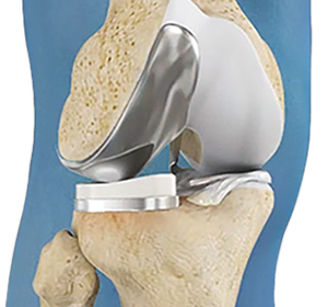 Unicompartmental/Partial Knee Replacement