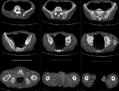 Hip CT Scan Image