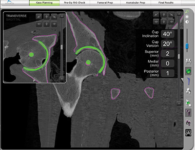 Hip personalized planning Image