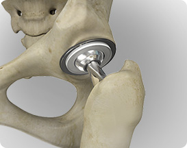 Advanced Hip Replacement