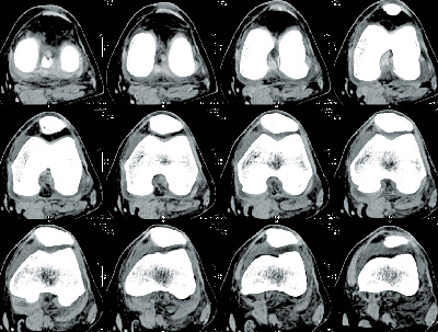 Knee CT Scan Image