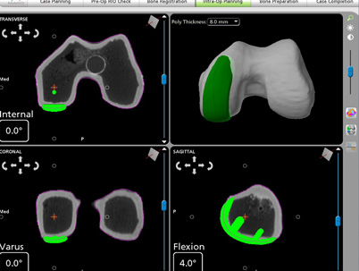 Knee personalized planning Image