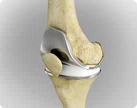 Advanced Knee Replacement