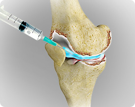 Hip and Knee Arthritis Care
