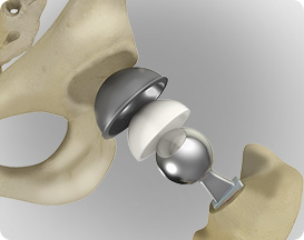Same-Day Joint Replacement