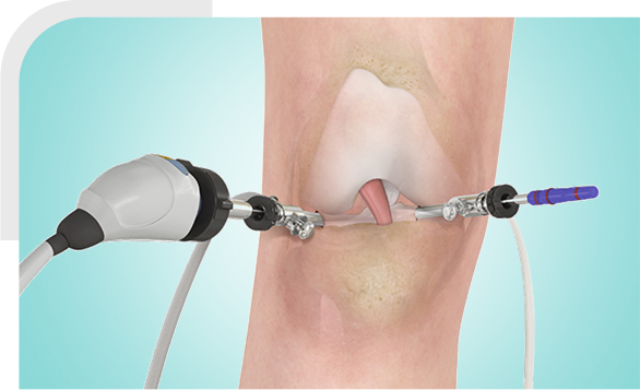 ACL Reconstruction img