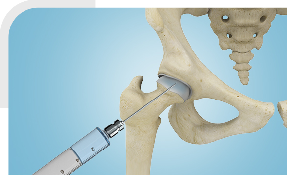 Hyaluronic Acid Injections img