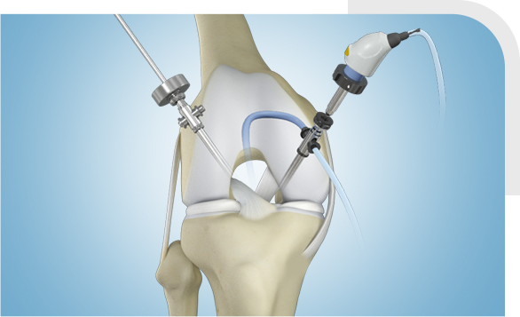 Knee Arthroscopy img
