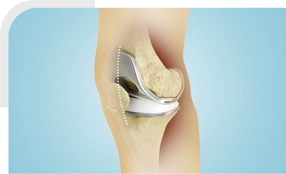 Minimally Invasive Knee Replacement img
