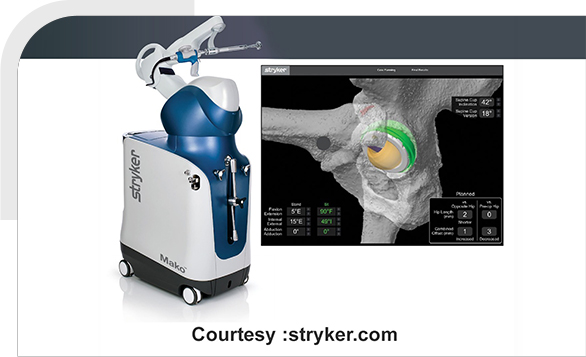 Robotic-Assisted Hip Replacement img
