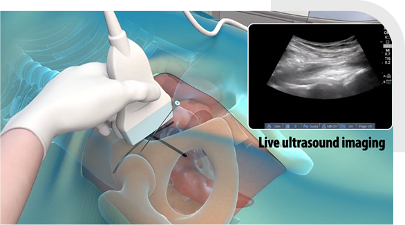 Ultrasound-Guided Injections img