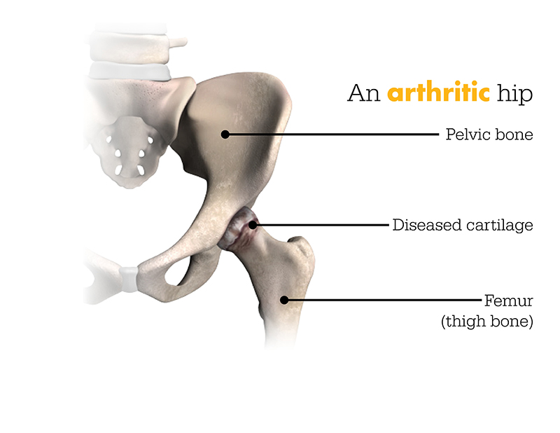 Arthritic Hip Image