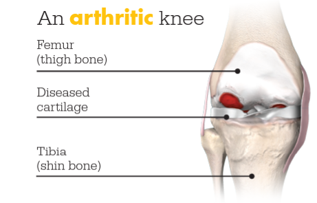 Arthritic Knee Image