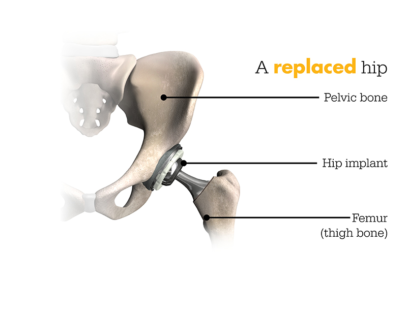 Replaced Hip Image