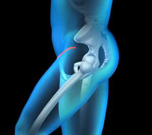 Bikini Incision Hip Replacement
