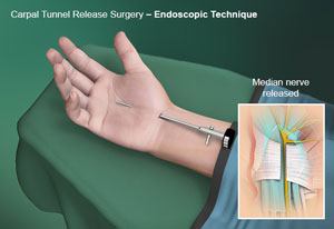Carpal Tunnel Release Surgery pic