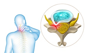 Cervical Myelopathy