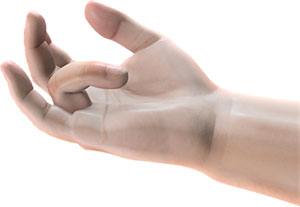 Dupuytren's Contracture pic