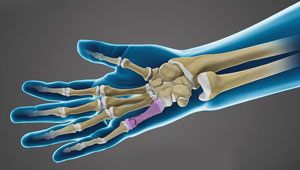 Hand Fracture Care pic