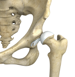 Hip Instability