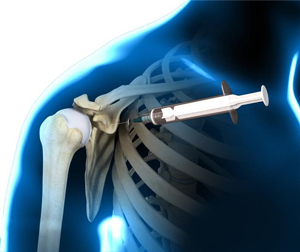 Hyaluronic Acid Injections